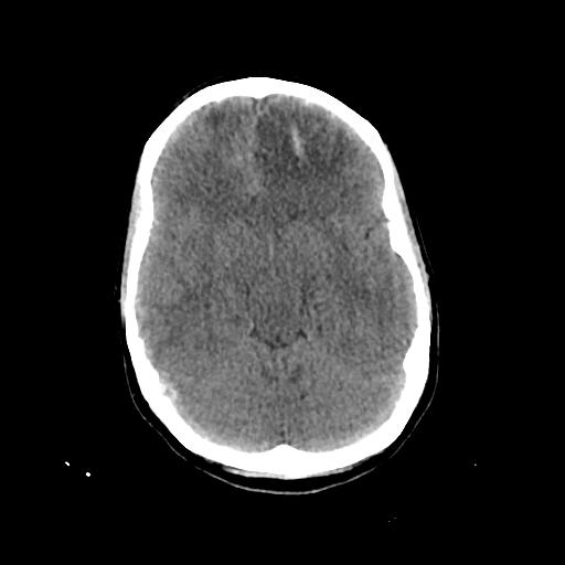 File:Cerebral venous throbmosis - hemorrhagic venous infarction (Radiopaedia 87318-103613 Axial non-contrast 64).jpg