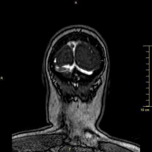 Cerebral venous thrombosis (Radiopaedia 23288-23351 MRV 168).JPG