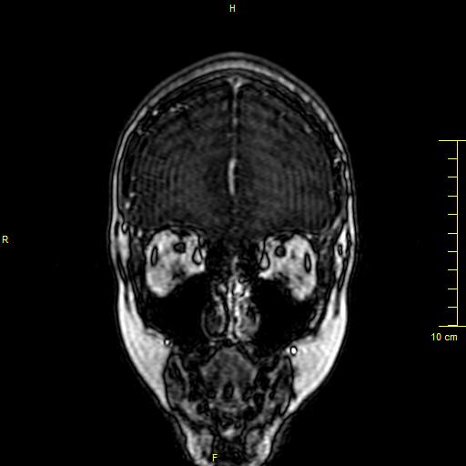 Cerebral venous thrombosis (Radiopaedia 23288-23351 MRV 6).JPG
