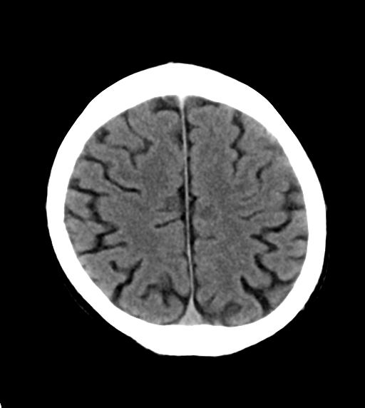 File:Cerebral venous thrombosis (Radiopaedia 38392-40467 Axial non-contrast 22).png