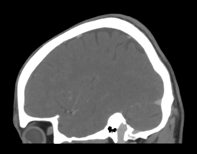 Cerebral venous thrombosis (Radiopaedia 38392-40467 D 39).png