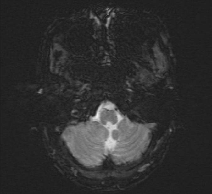 Cerebral venous thrombosis (Radiopaedia 71207-81504 Axial SWI 4).jpg