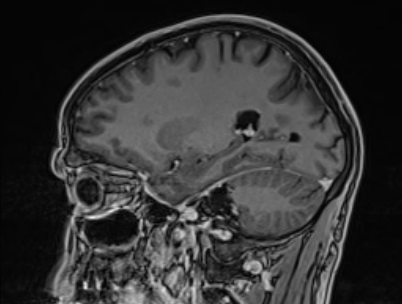 Cerebral venous thrombosis (Radiopaedia 71207-81504 Sagittal T1 C+ 20).jpg