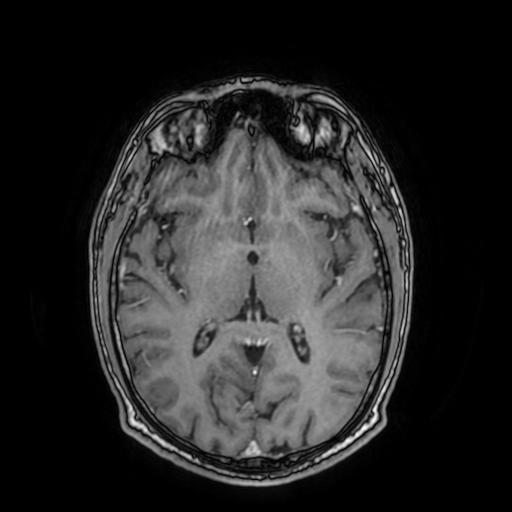 File:Cerebral venous thrombosis with secondary intracranial hypertension (Radiopaedia 89842-106957 Axial T1 C+ 96).jpg