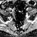 File:Cervical adenocarcinoma (Radiopaedia 65011-73985 Axial ADC 25).jpg