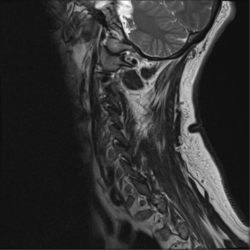 File:Cervical canal stenosis due to ossification of the posterior longitudinal ligament (Radiopaedia 47260-51824 Sagittal T2 1).png