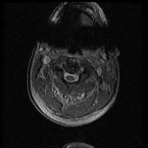 File:Cervical canal stenosis with cord compression (Radiopaedia 34114-35374 Axial Gradient Echo 77).png