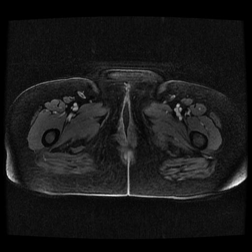 Cervical carcinoma (Radiopaedia 70924-81132 Axial T1 C+ fat sat 190).jpg