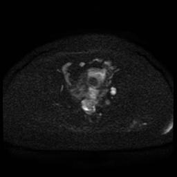 Cervical carcinoma (Radiopaedia 85405-101028 Axial DWI 71).jpg
