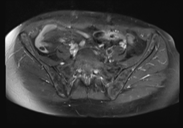 File:Cervical carcinoma (Radiopaedia 88312-104943 Axial T1 C+ fat sat 5).jpg