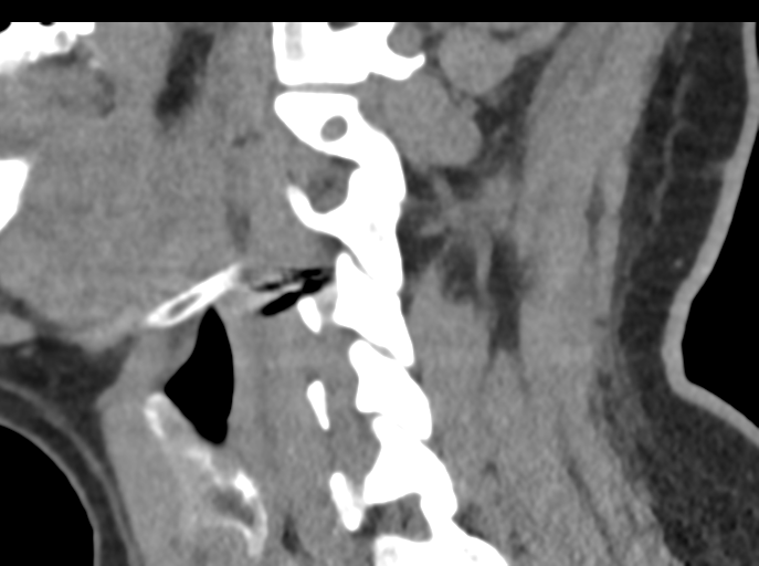 File:Cervical disc replacement (Radiopaedia 44025-47541 B 37).png