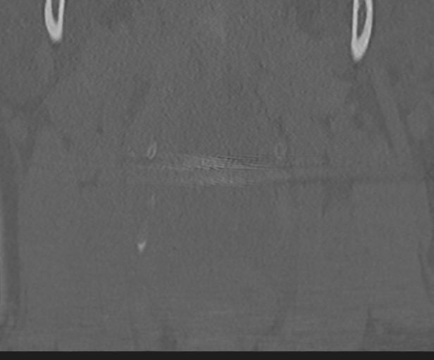 Cervical disc replacement (Radiopaedia 44025-47541 Coronal bone window 8).png