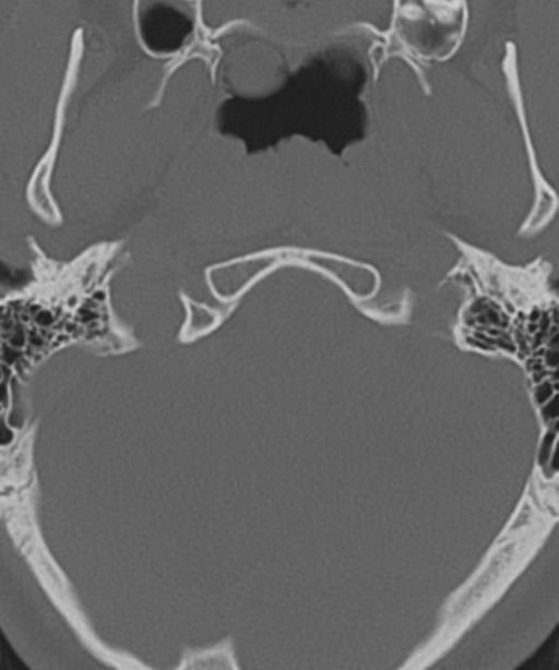 Cervical intercalary bone (Radiopaedia 35211-36748 Axial bone window 6).png