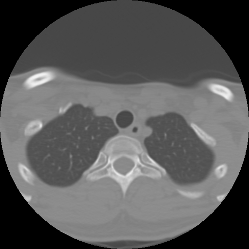 Cervical rib (Radiopaedia 71110-81363 Axial non-contrast 53).jpg