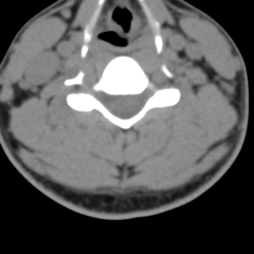 Cervical schwannoma (Radiopaedia 57979-64974 Axial non-contrast 38).png