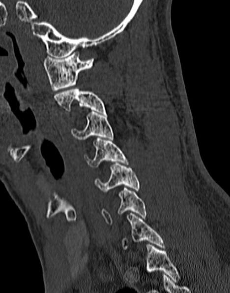 Cervical spondylodiscitis (Radiopaedia 28057-29489 Sagittal bone window 24).jpg