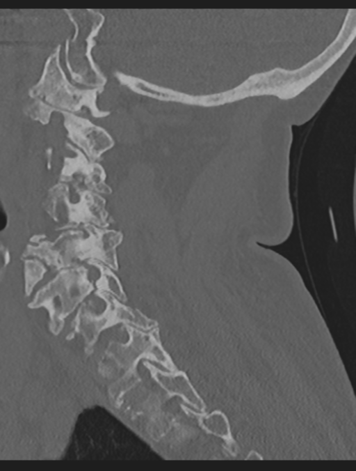 Cervical spondylolysis (Radiopaedia 49616-54811 Sagittal bone window 28).png