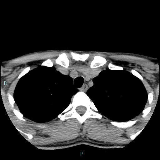 Cervical thymic cyst (Radiopaedia 88632-105335 Axial non-contrast 15).jpg