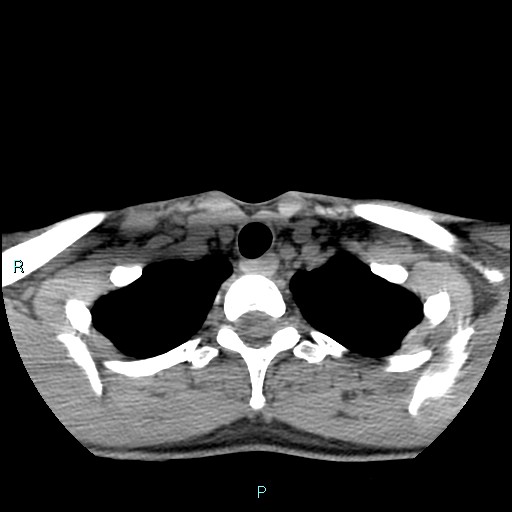 Cervical thymic cyst (Radiopaedia 88632-105335 Axial non-contrast 29).jpg