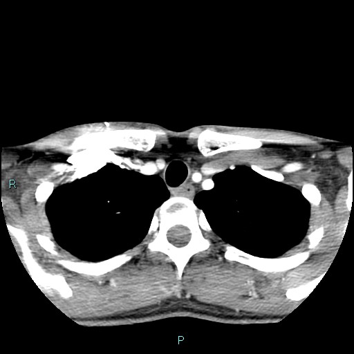 Cervical thymic cyst (Radiopaedia 88632-105335 B 22).jpg