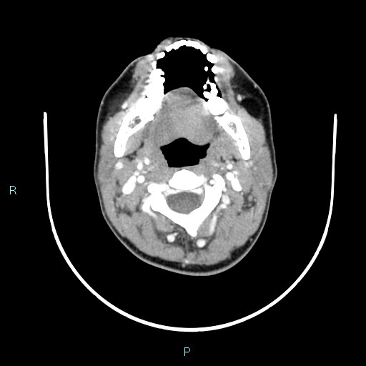 Cervical thymic cyst (Radiopaedia 88632-105335 B 84).jpg