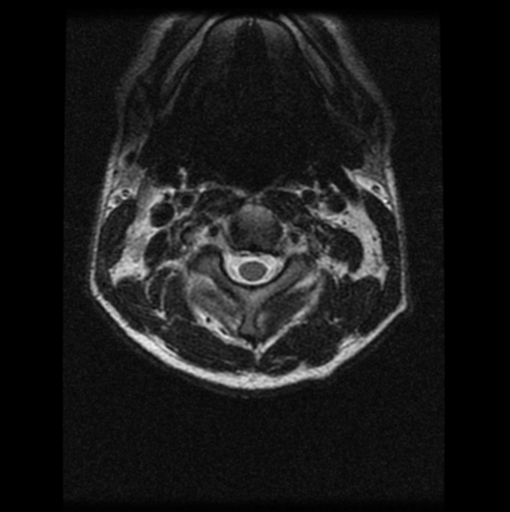 File:Cervical vertebrae metastasis (Radiopaedia 78814-91667 Axial T2 19).png