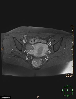 File:Cesarian scar endometriosis (Radiopaedia 68495-78066 Axial T1 C+ fat sat 14).jpg