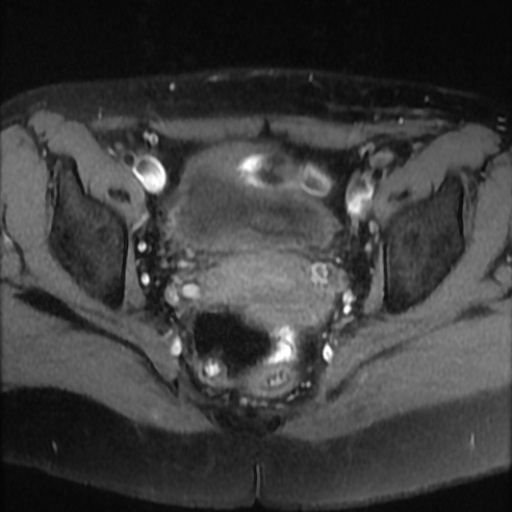 File:Cesarian section scar endometriosis (Radiopaedia 66520-75799 Axial T1 fat sat 15).jpg