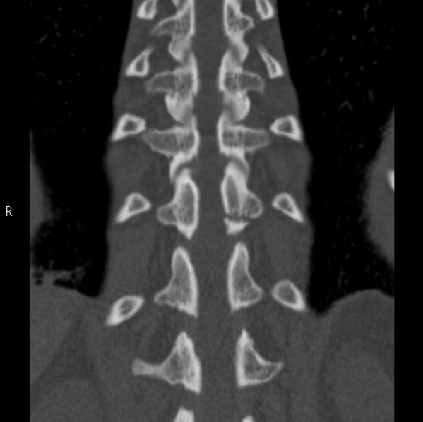 File:Chance fracture (Radiopaedia 36521-38081 Coronal bone window 45).jpg