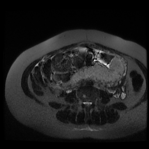 Chiari II malformation - fetal MRI (Radiopaedia 68099-77581 Axial T2-SSFSE 12).jpg