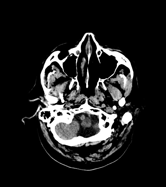 Cholangiocarcinoma with cerebral metastases (Radiopaedia 83519-98628 Axial non-contrast 13).jpg