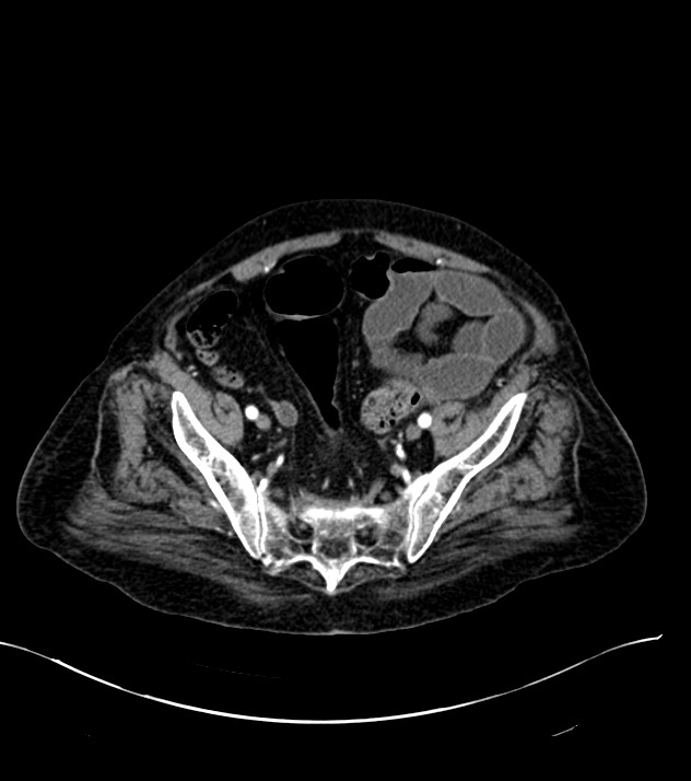 Cholangiocarcinoma with cerebral metastases (Radiopaedia 83519-98629 B 100).jpg