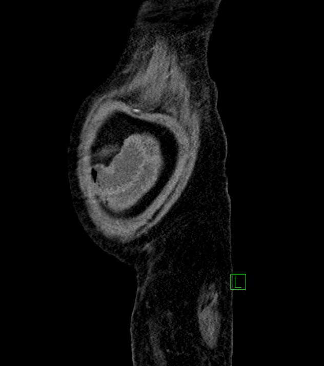 Cholangiocarcinoma with cerebral metastases (Radiopaedia 83519-98629 F 11).jpg