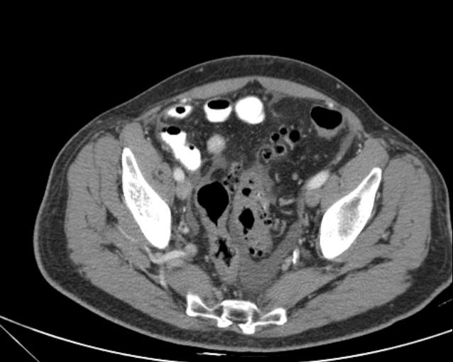 Cholecystitis - perforated gallbladder (Radiopaedia 57038-63916 A 70).jpg