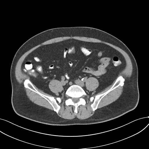 Cholecystitis with focal perforation and hepatic abscess (Radiopaedia 37189-38945 Axial non-contrast 59).png