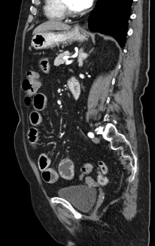 Cholecystoduodenal fistula due to calculous cholecystitis with gallstone migration (Radiopaedia 86875-103077 C 26).jpg