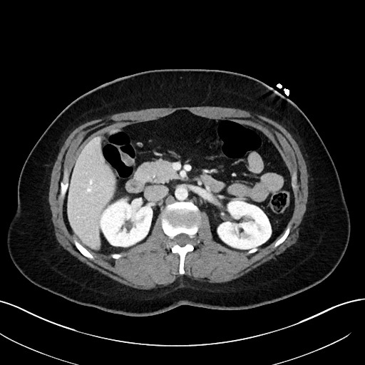 File:Choledocholithiasis after recent cholecystectomy (Radiopaedia 60929-68737 Axial 19).jpg