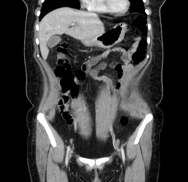 Choledocholithiasis on CT and MRI (Radiopaedia 24825-25087 C 16).jpg