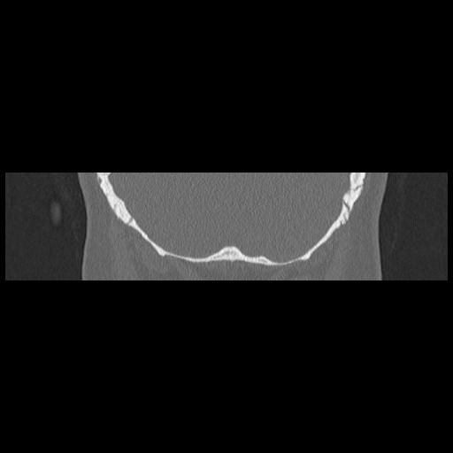 Cholesteatoma (Radiopaedia 84946-100455 Coronal bone window 135).jpg