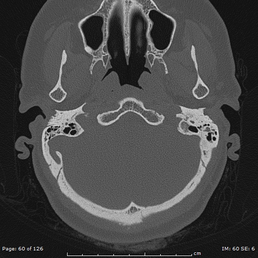 Cholesteatoma - external auditory canal (Radiopaedia 88452-105096 Axial bone window 23).jpg