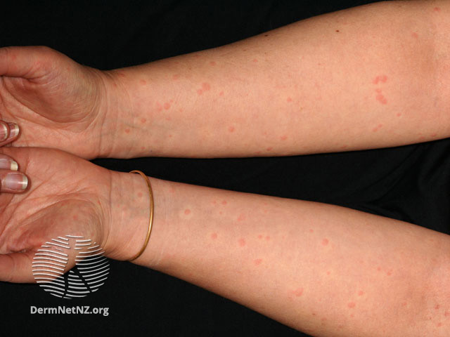 File:Cholinergic urticaria (DermNet NZ reactions-s-cholinergic3).jpg