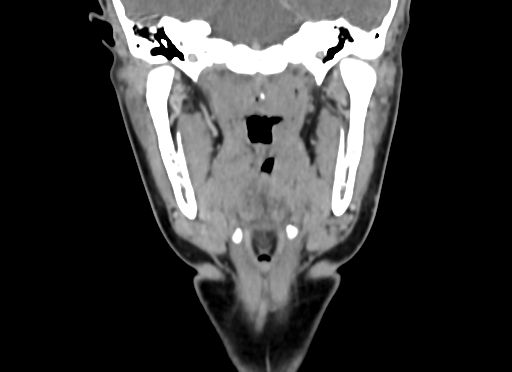 File:Chondroblastic osteosarcoma (Radiopaedia 67363-76741 D 63).jpg