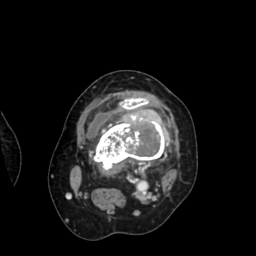 File:Chondrosarcoma - femur (Radiopaedia 64187-72954 Axial with contrast 35).jpg