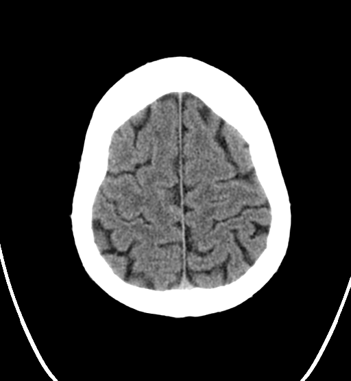 File:Chondrosarcoma of skull base- grade II (Radiopaedia 40948-43653 Axial non-contrast 25).png