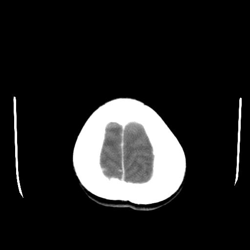 File:Choriocarcinoma of ovary with cerebral and pulmonary metastases (Radiopaedia 25983-26118 A 25).jpg
