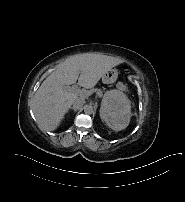 Chromophobe renal cell carcinoma (Radiopaedia 84239-99519 Axial non-contrast 56).jpg
