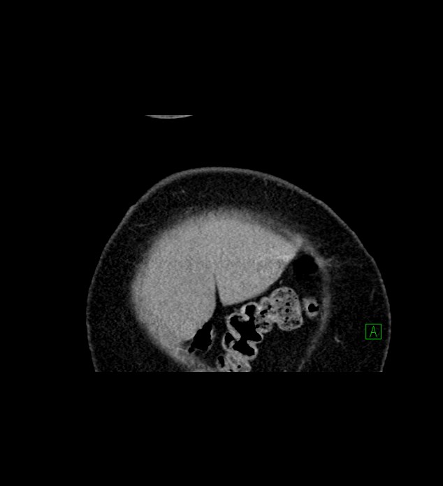 Chromophobe renal cell carcinoma (Radiopaedia 84239-99519 C 6).jpg