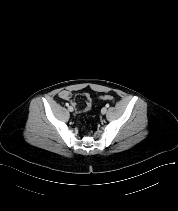 Chromophobe renal cell carcinoma (Radiopaedia 84255-99542 F 69).jpg
