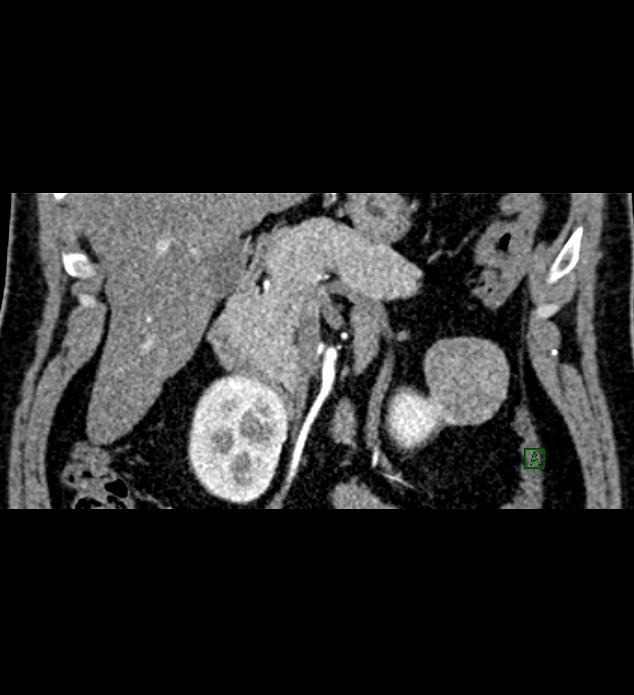 Chromophobe renal cell carcinoma (Radiopaedia 84286-99573 E 18).jpg