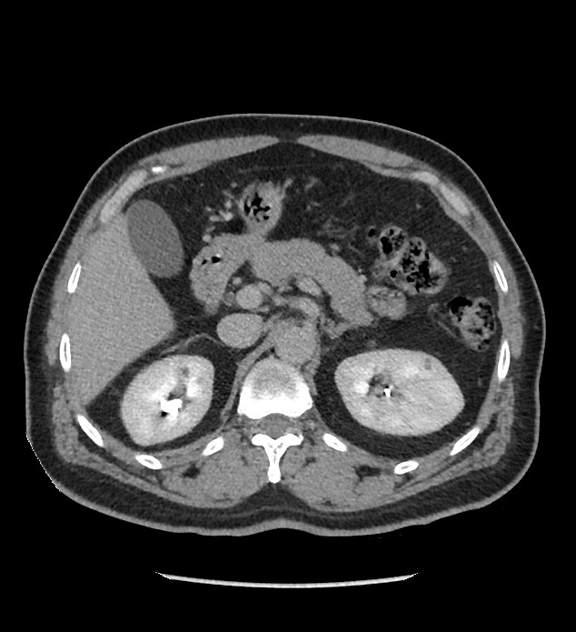 Chromophobe renal cell carcinoma (Radiopaedia 86879-103083 D 44).jpg